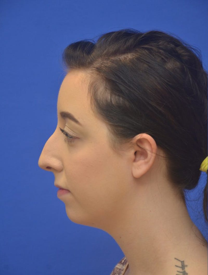 Rhinoplasty Before & After Gallery - Patient 298784 - Image 5