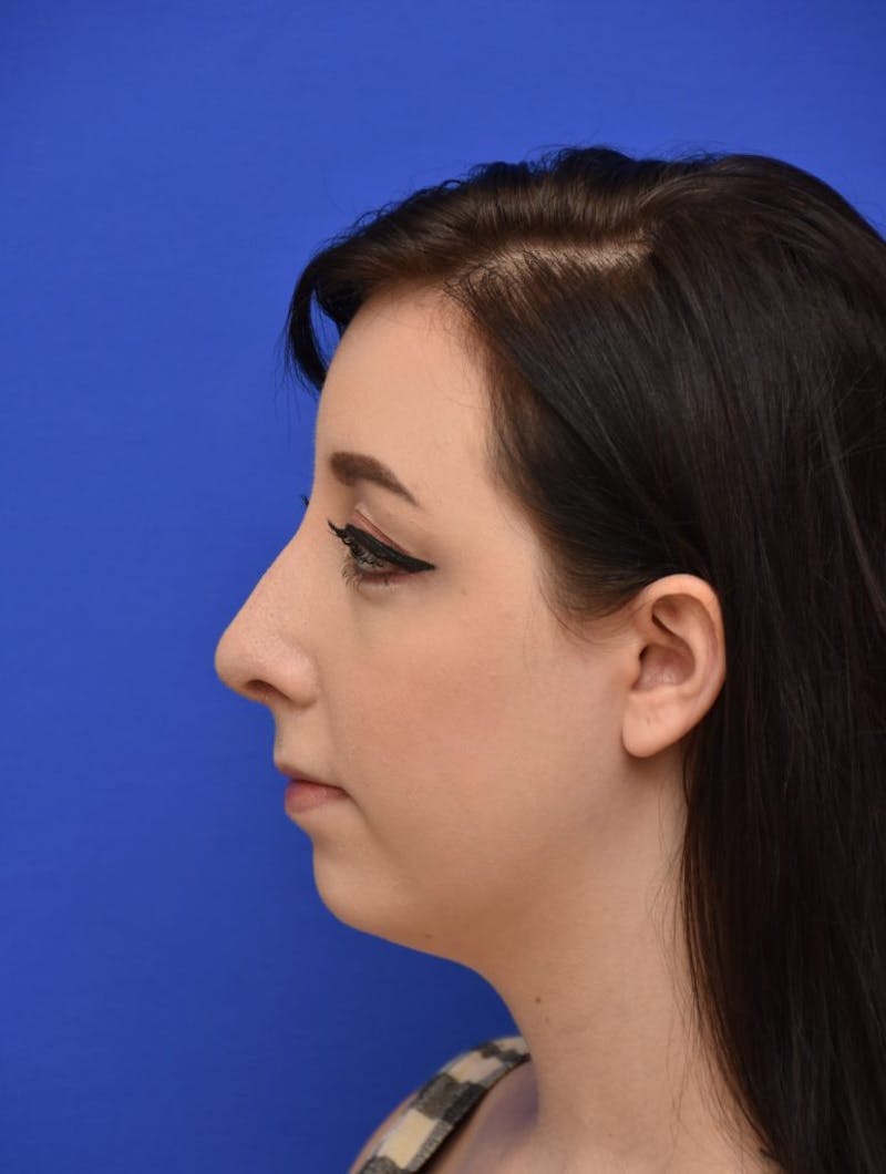 Rhinoplasty Before & After Gallery - Patient 298784 - Image 6