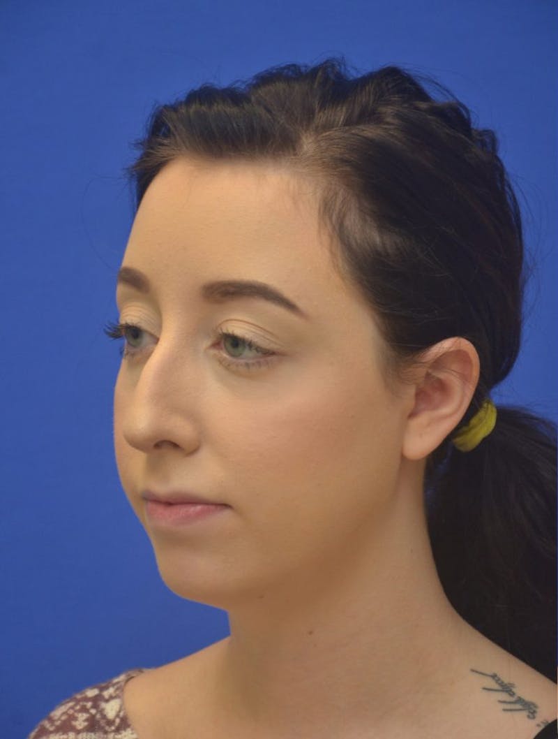Rhinoplasty Before & After Gallery - Patient 298784 - Image 7