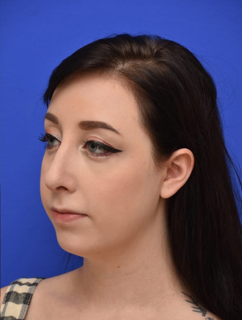 Rhinoplasty Before & After Gallery - Patient 298784 - Image 8
