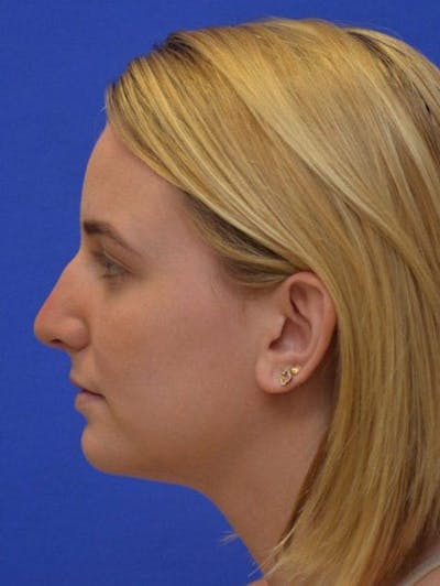 Rhinoplasty Before & After Gallery - Patient 321242 - Image 1