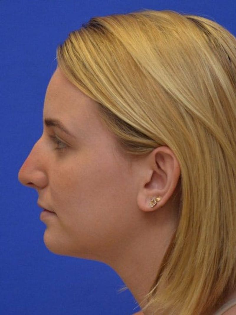 Rhinoplasty Before & After Gallery - Patient 321242 - Image 1