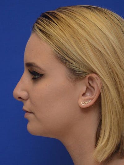 Rhinoplasty Before & After Gallery - Patient 321242 - Image 2