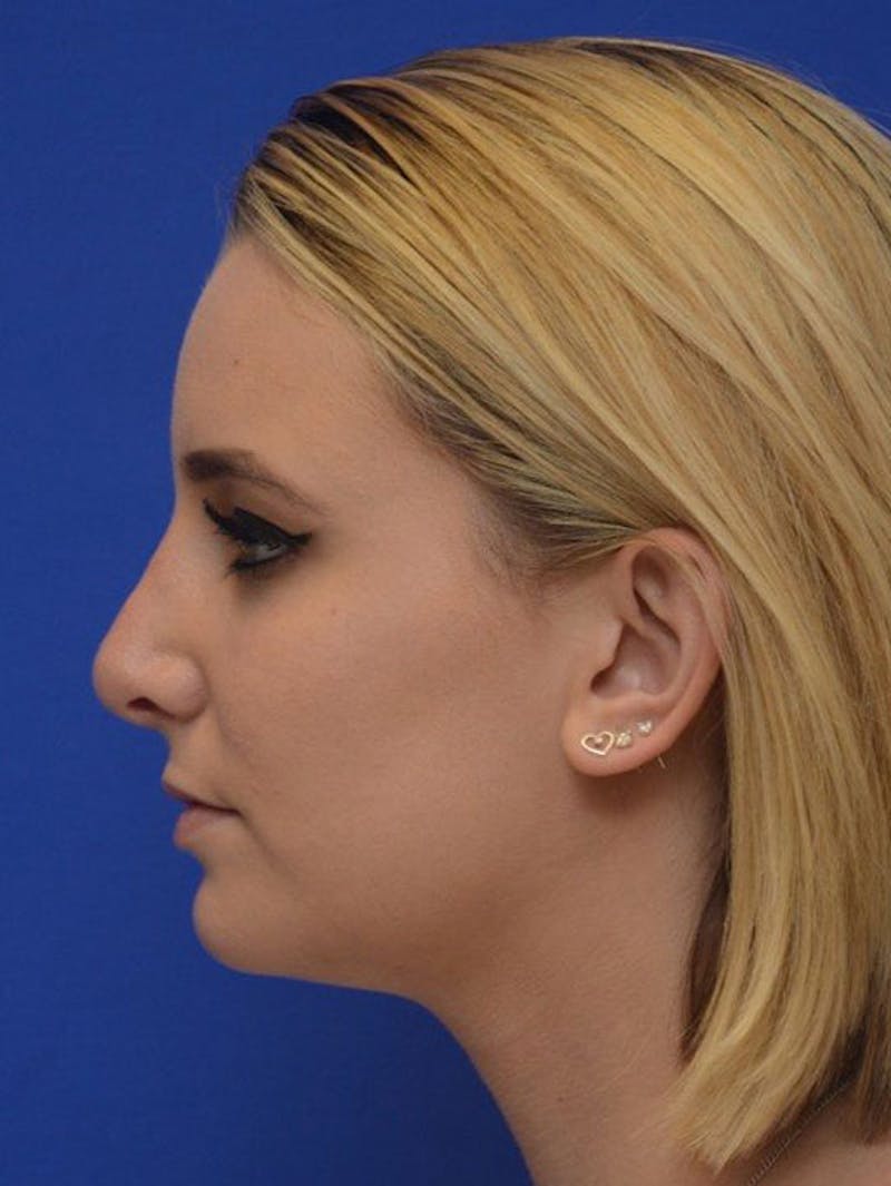 Rhinoplasty Before & After Gallery - Patient 321242 - Image 2