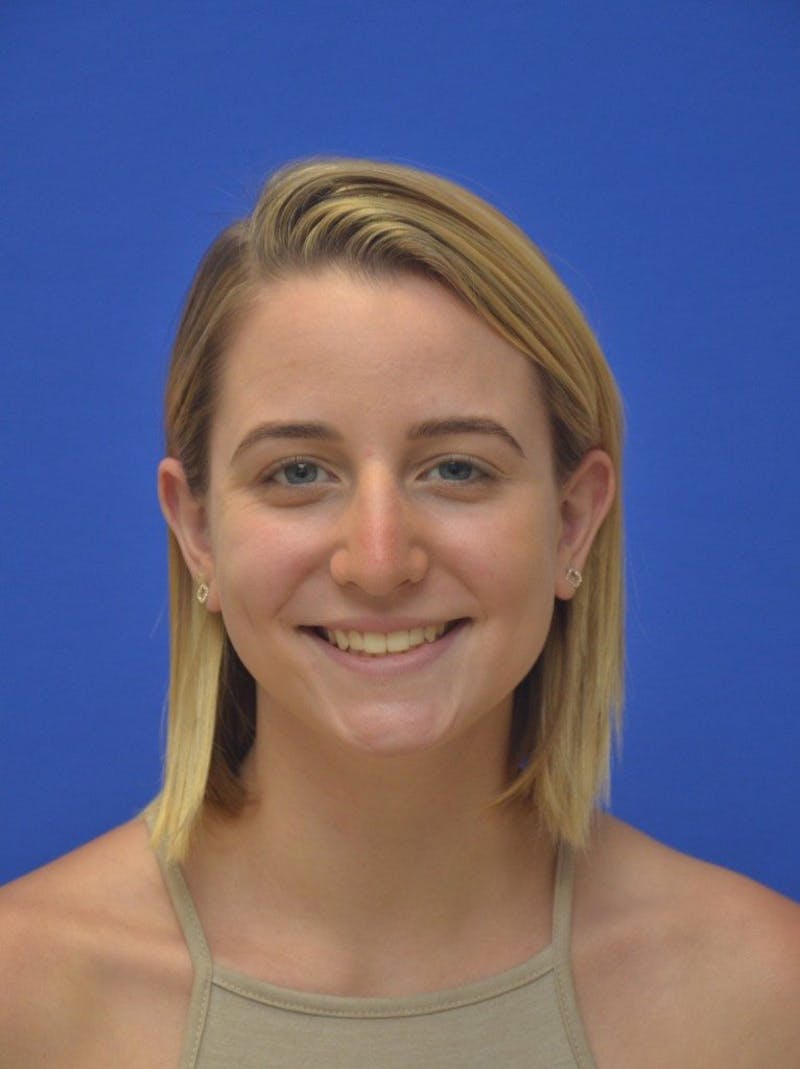 Rhinoplasty Before & After Gallery - Patient 321242 - Image 3