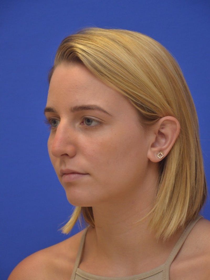 Rhinoplasty Before & After Gallery - Patient 321242 - Image 5