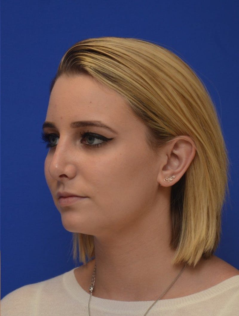 Rhinoplasty Before & After Gallery - Patient 321242 - Image 6