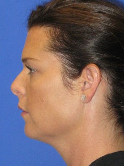Rhinoplasty Before & After Gallery - Patient 107040 - Image 1
