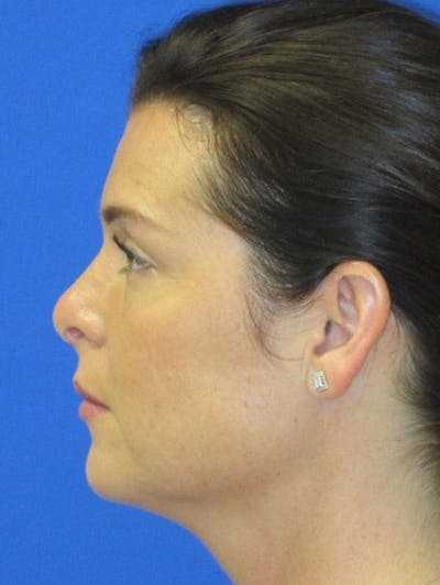 Rhinoplasty Before & After Gallery - Patient 107040 - Image 2