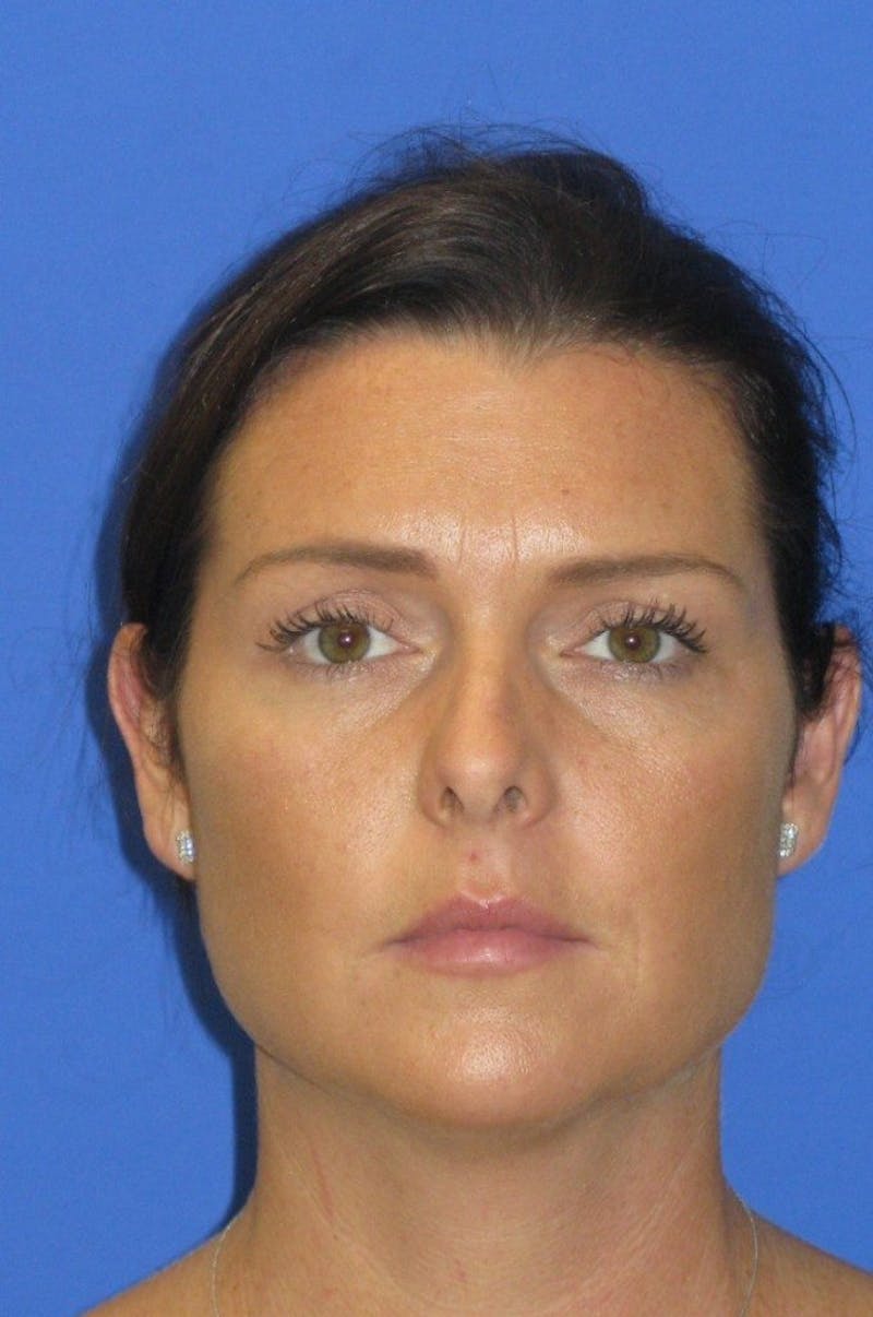 Rhinoplasty Before & After Gallery - Patient 107040 - Image 3