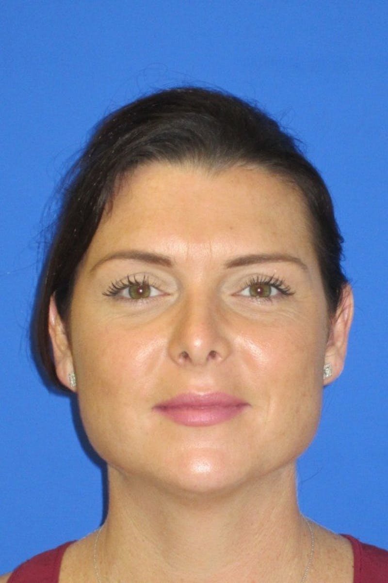 Rhinoplasty Before & After Gallery - Patient 107040 - Image 4