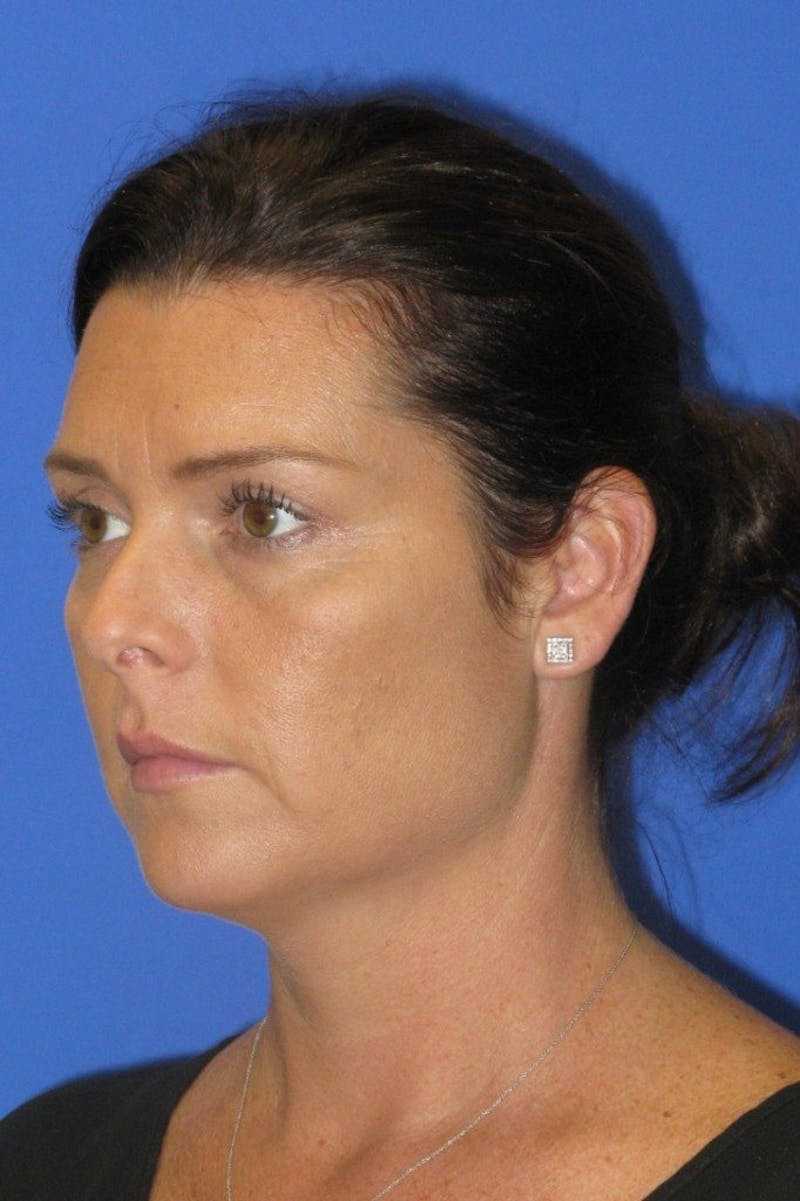 Rhinoplasty Before & After Gallery - Patient 107040 - Image 5