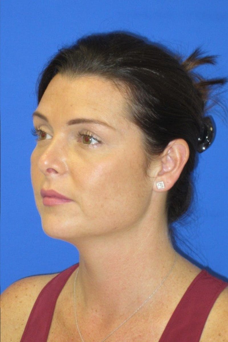 Rhinoplasty Before & After Gallery - Patient 107040 - Image 6
