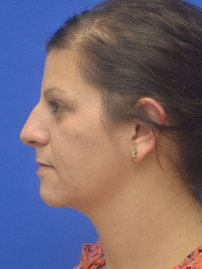 Rhinoplasty Before & After Gallery - Patient 292690 - Image 1