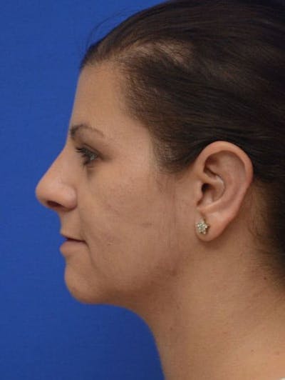 Rhinoplasty Before & After Gallery - Patient 292690 - Image 2