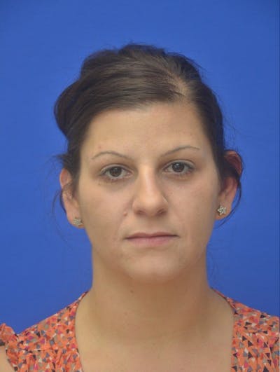 Ear Pinning Surgery Before & After Gallery - Patient 261073 - Image 1