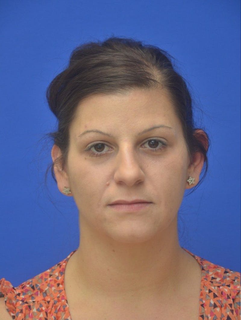 Rhinoplasty Before & After Gallery - Patient 292690 - Image 3