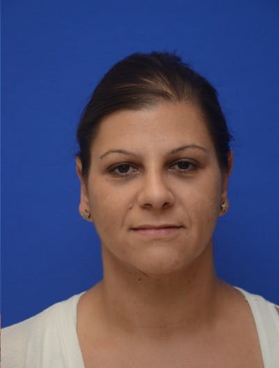 Ear Pinning Surgery Before & After Gallery - Patient 261073 - Image 2