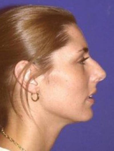 Rhinoplasty Before & After Gallery - Patient 124489 - Image 1