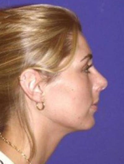 Rhinoplasty Before & After Gallery - Patient 124489 - Image 2