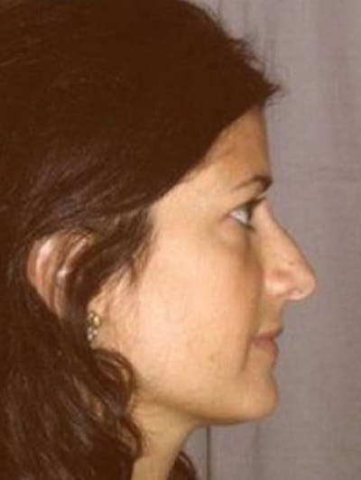Rhinoplasty Before & After Gallery - Patient 106835 - Image 1