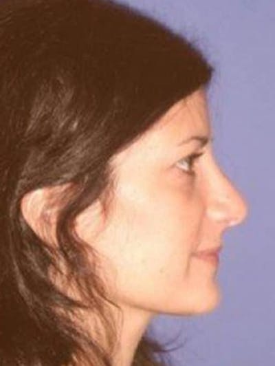Rhinoplasty Before & After Gallery - Patient 106835 - Image 2