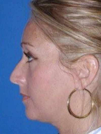 Rhinoplasty Before & After Gallery - Patient 108765 - Image 1