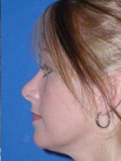 Rhinoplasty Before & After Gallery - Patient 108765 - Image 2