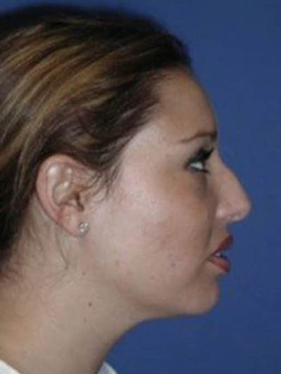 Rhinoplasty Before & After Gallery - Patient 430632 - Image 1