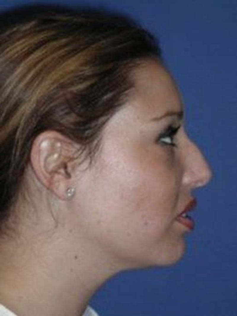 Rhinoplasty Before & After Gallery - Patient 430632 - Image 1