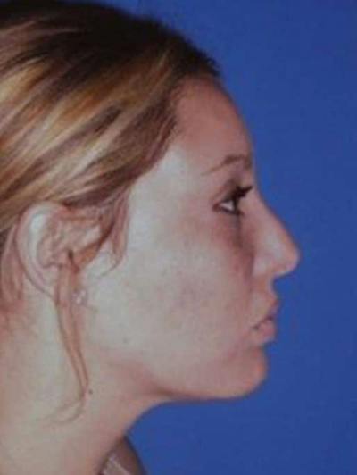 Rhinoplasty Before & After Gallery - Patient 430632 - Image 2