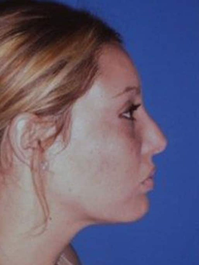 Rhinoplasty Before & After Gallery - Patient 430632 - Image 2