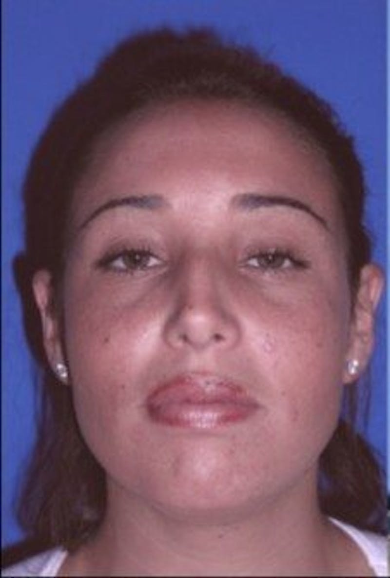 Rhinoplasty Before & After Gallery - Patient 430632 - Image 3