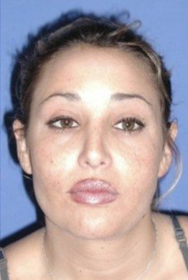 Rhinoplasty Before & After Gallery - Patient 430632 - Image 4