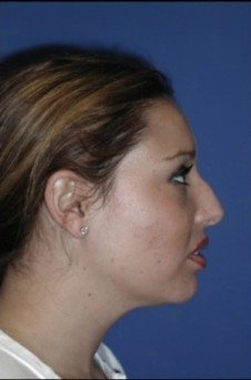 Rhinoplasty Before & After Gallery - Patient 430632 - Image 5