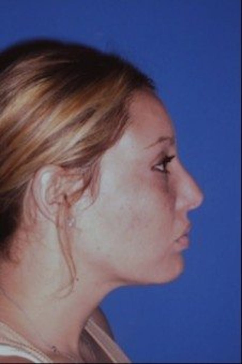 Rhinoplasty Before & After Gallery - Patient 430632 - Image 6