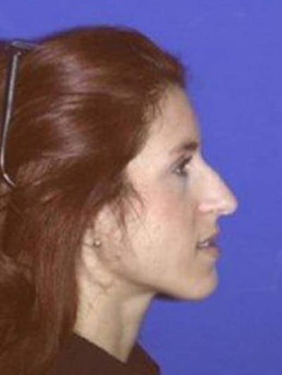 Rhinoplasty Before & After Gallery - Patient 247953 - Image 1
