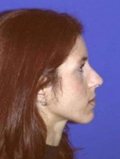Rhinoplasty Before & After Gallery - Patient 247953 - Image 2