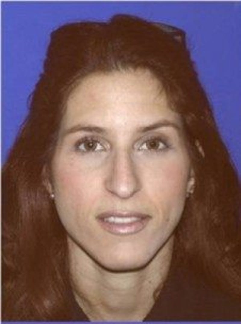 Rhinoplasty Before & After Gallery - Patient 247953 - Image 3