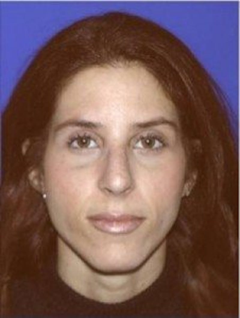 Rhinoplasty Before & After Gallery - Patient 247953 - Image 4