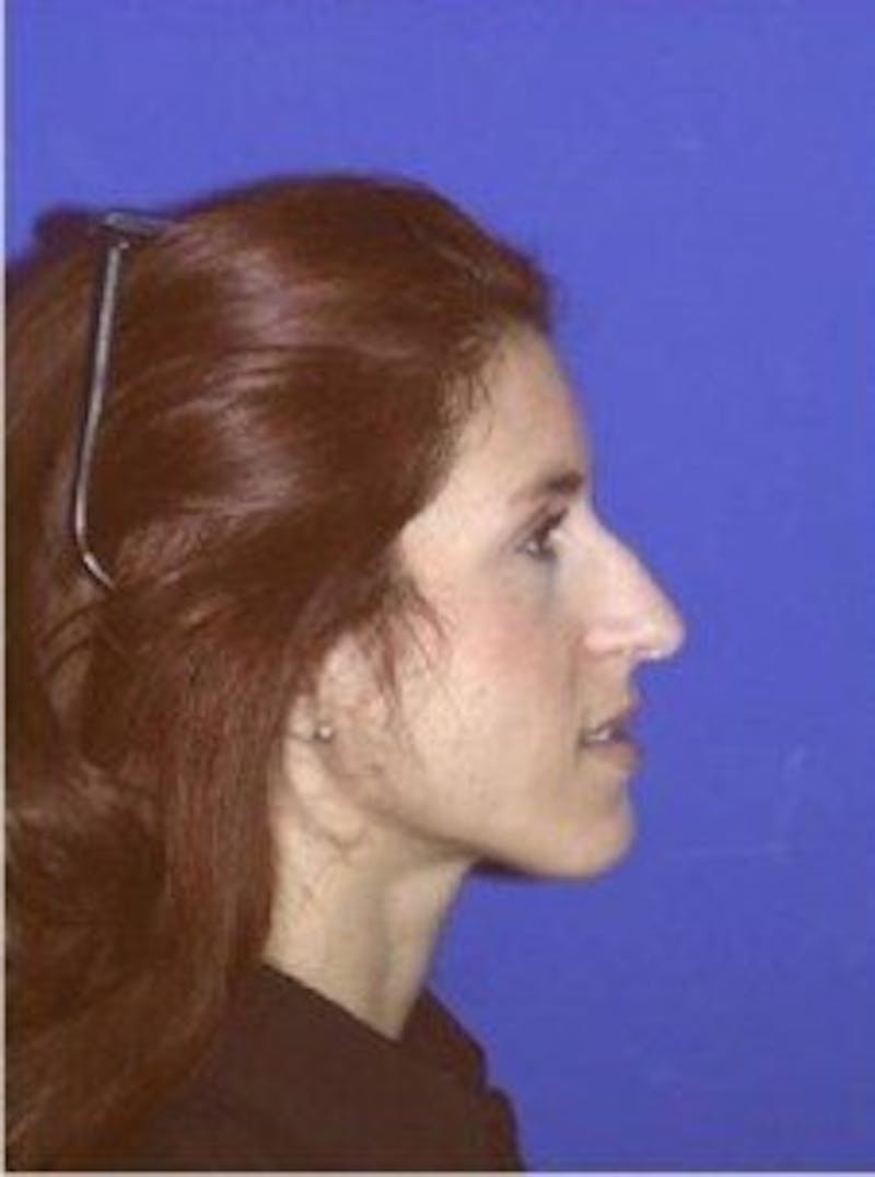 Rhinoplasty Before & After Gallery - Patient 247953 - Image 5