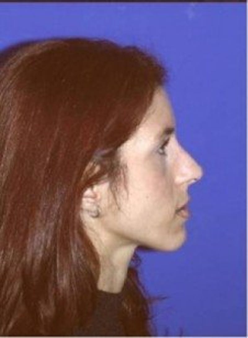 Rhinoplasty Before & After Gallery - Patient 247953 - Image 6