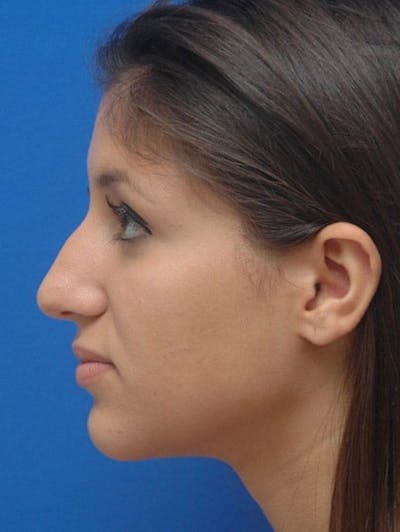 Rhinoplasty Before & After Gallery - Patient 183406 - Image 1