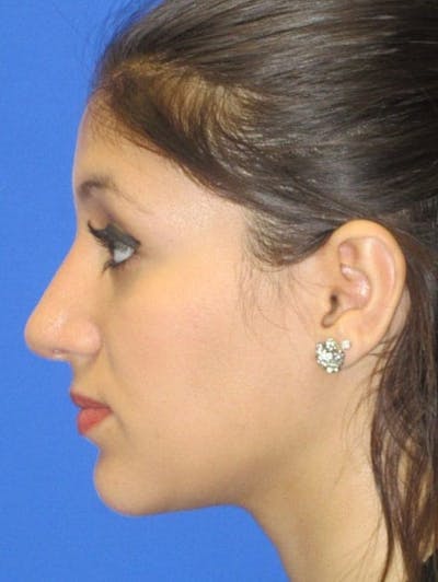 Rhinoplasty Before & After Gallery - Patient 183406 - Image 2