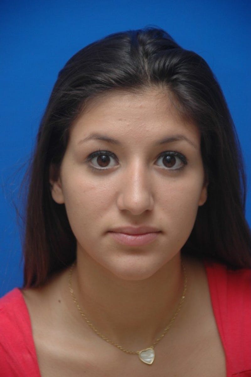 Rhinoplasty Before & After Gallery - Patient 183406 - Image 3