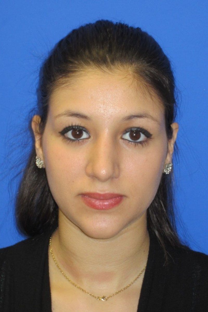 Rhinoplasty Before & After Gallery - Patient 183406 - Image 4