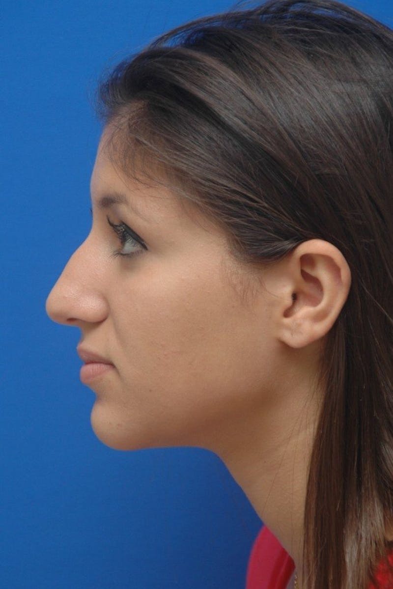 Rhinoplasty Before & After Gallery - Patient 183406 - Image 5