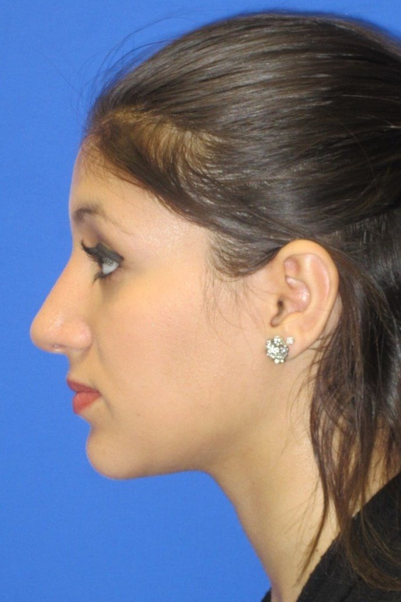 Rhinoplasty Before & After Gallery - Patient 183406 - Image 6