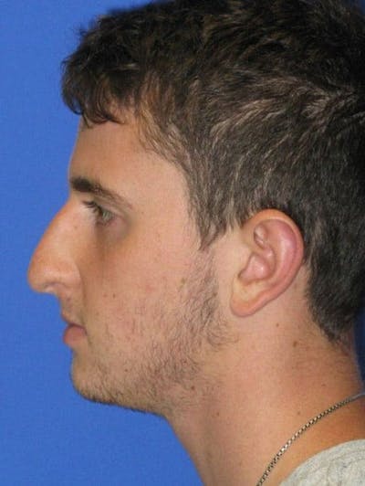 Rhinoplasty Before & After Gallery - Patient 128792 - Image 1