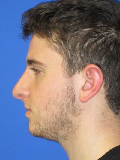 Rhinoplasty Before & After Gallery - Patient 128792 - Image 2